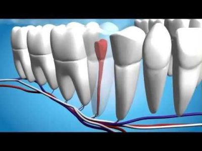 عصب کشی تک کاناله