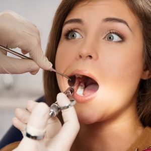 عصب کشی دندان