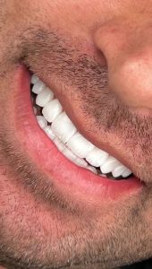 همه‌چیز درباره لمینت دندان