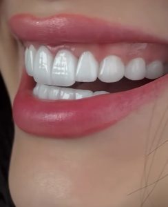 کامپوزیت دندان