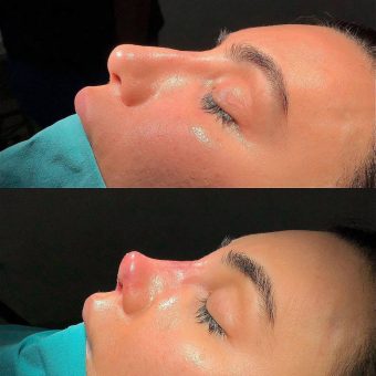 بهترین دکتر بینی فانتزی barbie