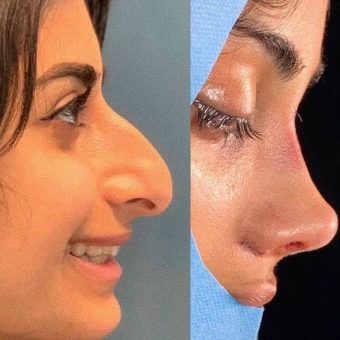 بهترین دکتر عمل بینی