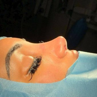 بینی فانتزی با بینی استخوانی