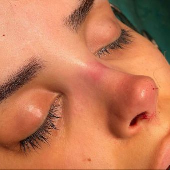 بینی هالیوودی