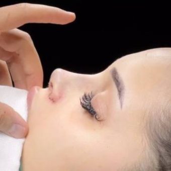 جراحی بینی عروسکی با بینی گوشتی