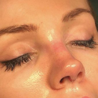 دالی نوز سرجری