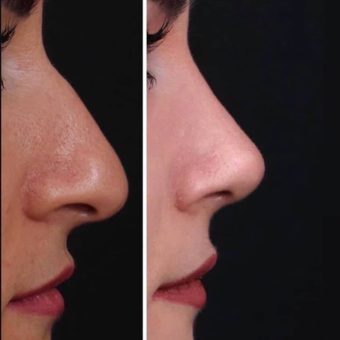 رینوپلاستی بینی طبیعی