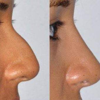 عمل بینی طبیعی زنانه