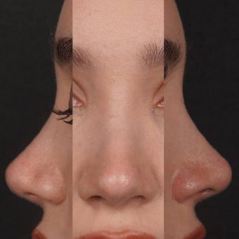 عمل بینی عروسکی