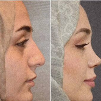 عمل بینی فانتزی