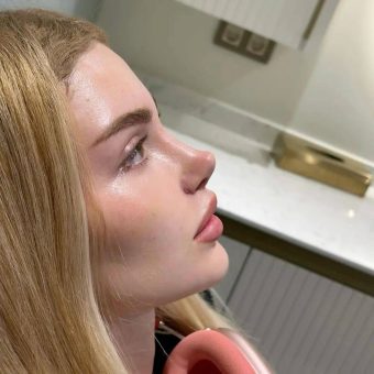 عمل بینی مدل باربی نوز