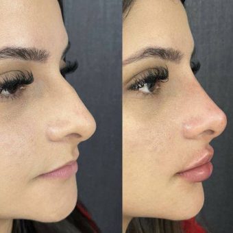 عمل بینی نچرال با قوس ملایم