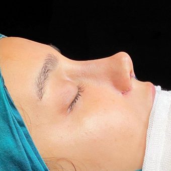 عمل بینی نیمه فانتزی