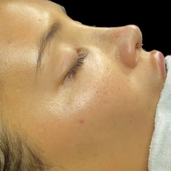 عمل بینی نیمه فانتزی + طبیغی