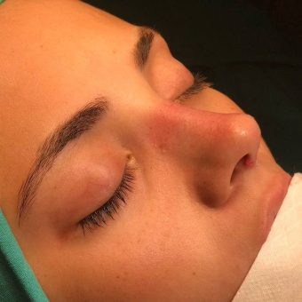 عمل زیبایی بینی به سبک عروسکی