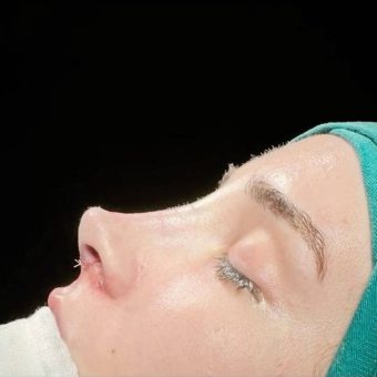 عمل فانتزب بینی گوشتی