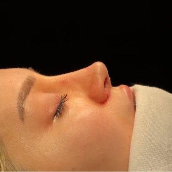 مدل عمل بینی باربی نوز طبیعی