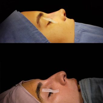 نمونه بینی مدل باربی و پرنسسی